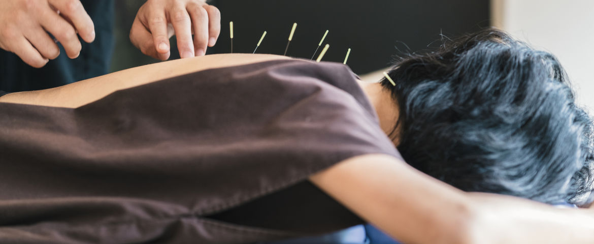 5 Things You Need to Know Before Trying Acupuncture
